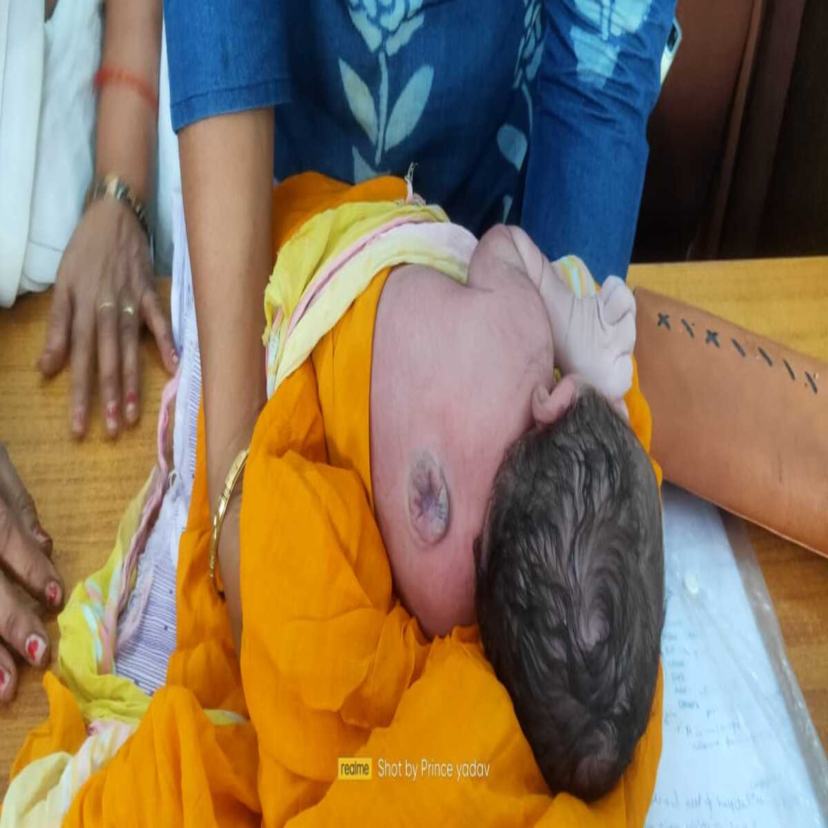 न्यूरल ट्यूब डिफेक्ट से